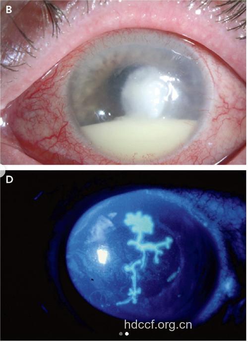 艾滋病真菌性角膜炎症状图片