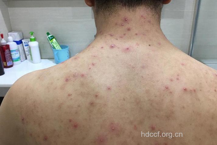 艾滋病皮疹图片 背部斑丘疹