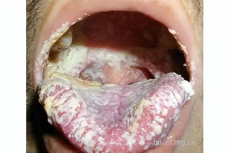 艾滋病症状图片 食道真菌病