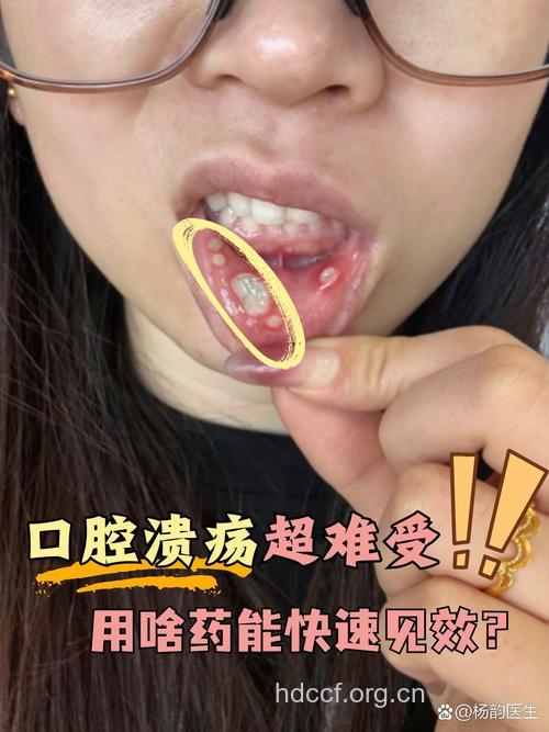 口腔溃疡苦不堪言