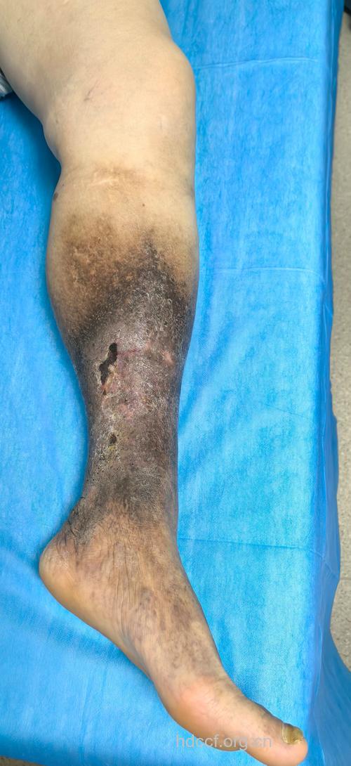 艾滋病症状图片 右下肢血栓性静脉炎