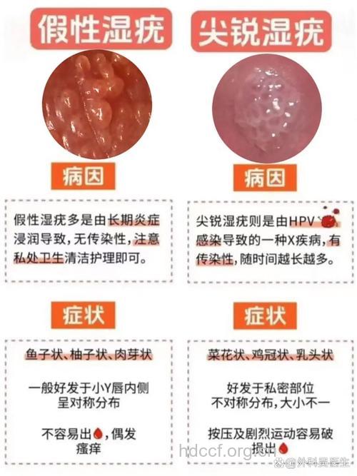 女性艾滋病尖锐湿疣图片