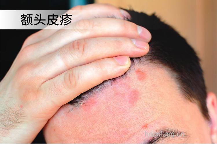 艾滋病初期症状图片 头癣