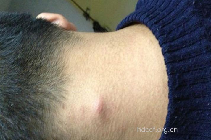 艾滋病之淋巴瘤图片