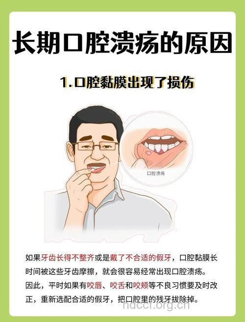 产生口腔溃疡的原因有多吗