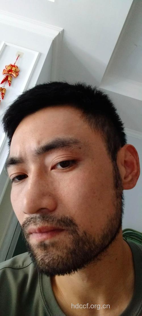 男性无胡须正常吗?