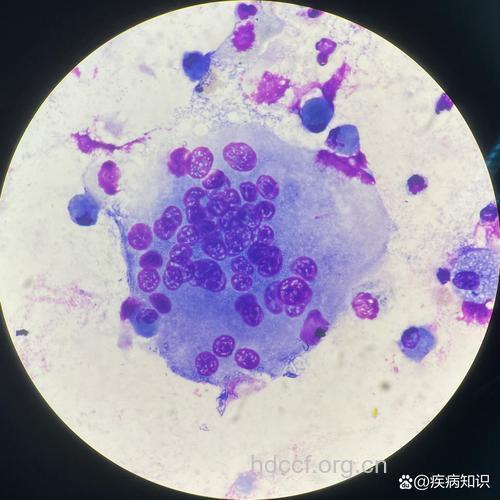 被艾滋病病毒感染的多核巨噬细胞 艾滋病患者可以结婚吗