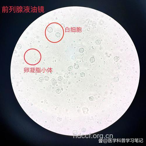 前列腺液的显微镜检查