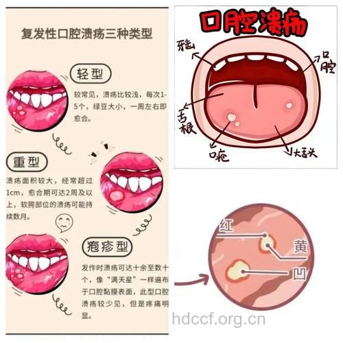口腔溃疡可分为3种类型