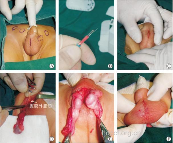 隐睾症的手术治疗