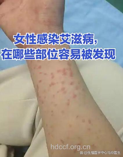 女患者讲述感染艾滋病的过程