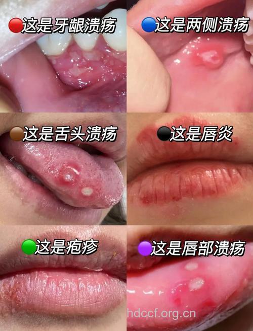 维生素治疗口腔溃疡的方法