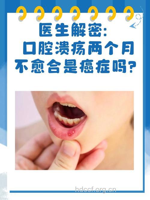 口腔溃疡不愈应防口腔癌