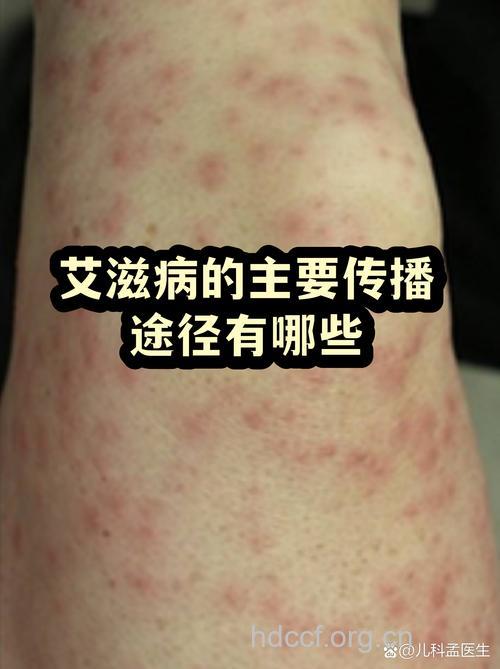 香港第二季百人感染艾滋病 105人为男性