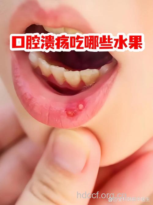 柑橘吃多亦会导致口腔溃疡