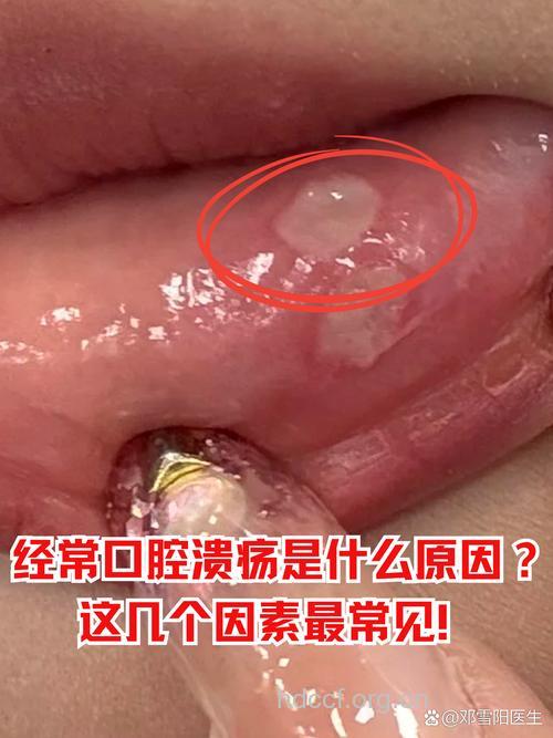 口腔溃疡的常见症状