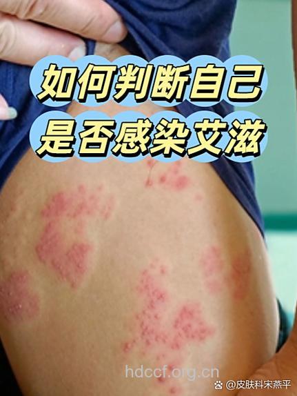 艾滋病故事 “娶”来的艾滋病