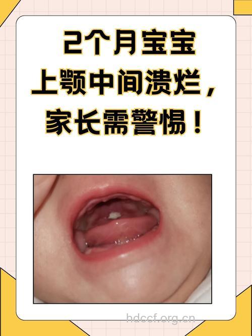 宝宝口腔溃疡的多种可能