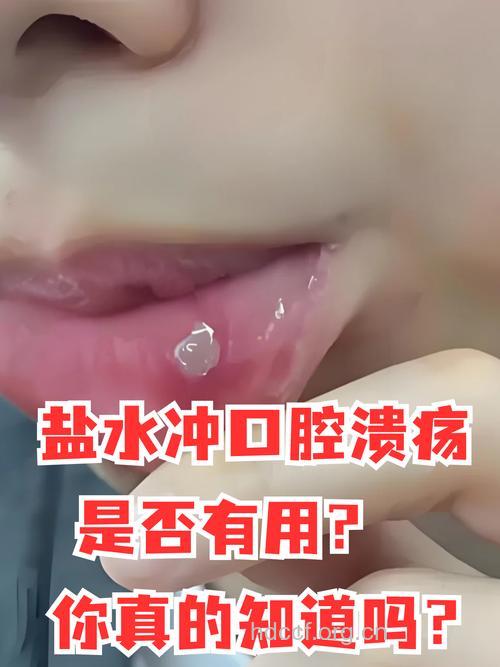 醋也能治疗口腔溃疡