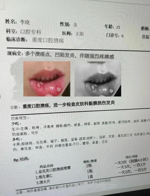 对口腔溃疡患者提的的几条建议