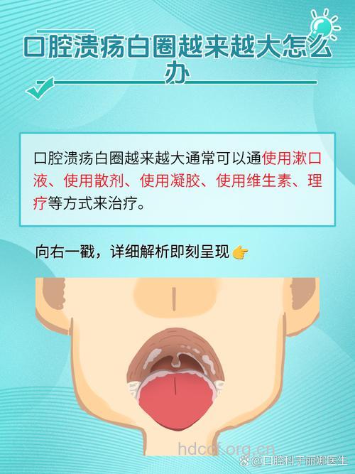 白塞氏口腔溃疡该知道的小常识