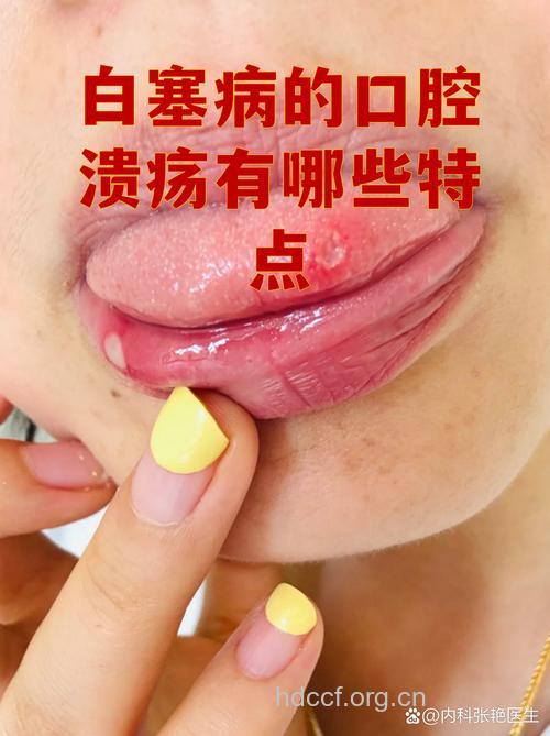 长期口腔溃疡当心变白塞氏病