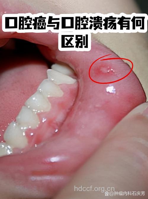 口腔溃疡还分良恶性