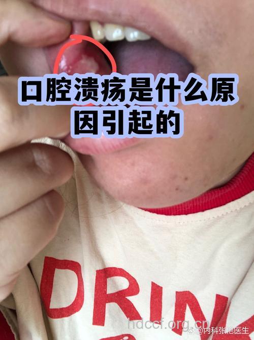 押运兵 小心口腔溃疡缠上你
