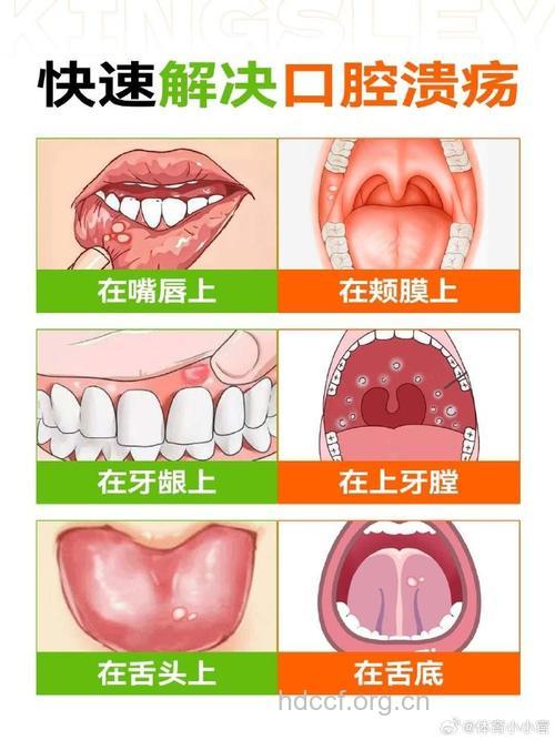 口腔溃疡也有秘密
