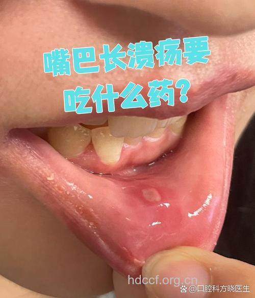 吃药也会引发的口腔溃疡