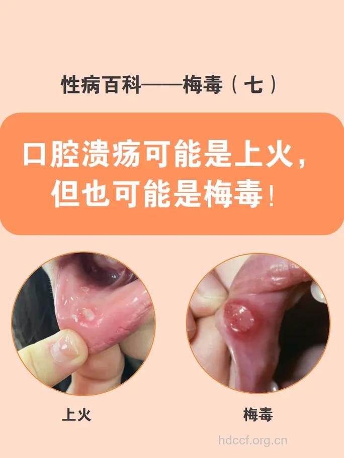 口腔溃疡会传染吗?