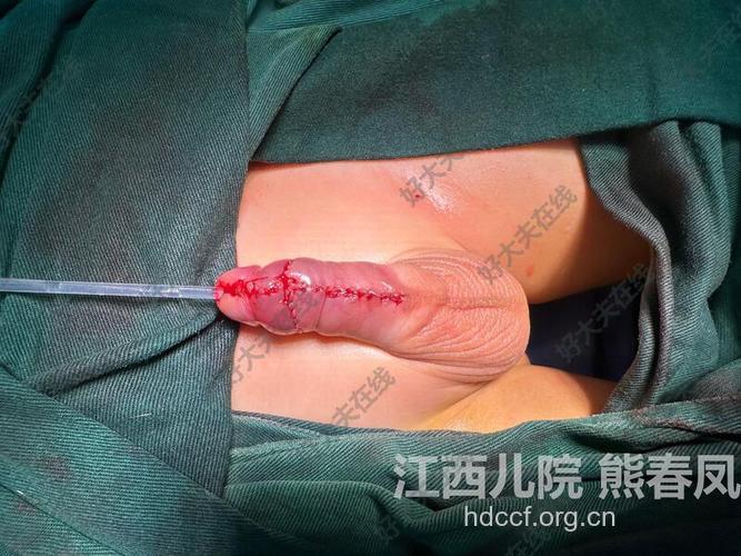 男性尿道下裂的点滴