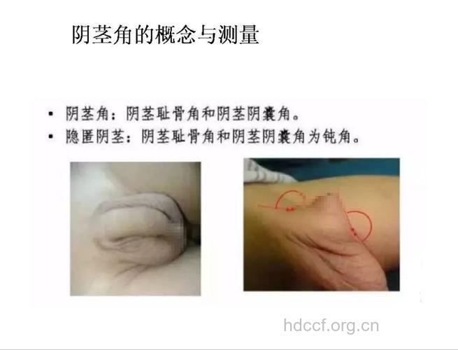 男人无阴茎是什么回事?