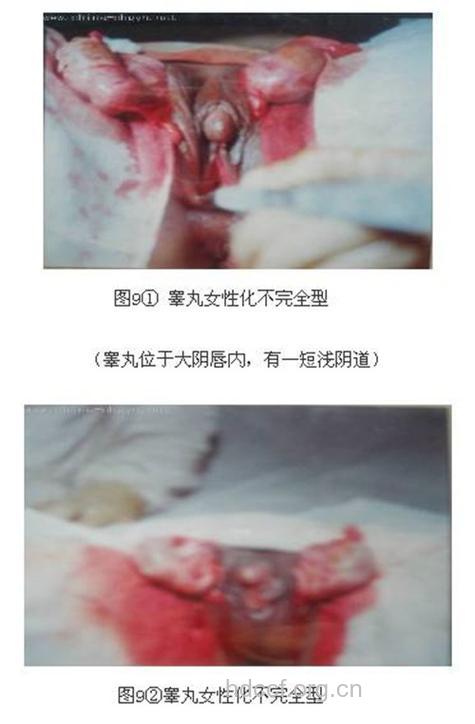 真两性畸形容易引起不孕