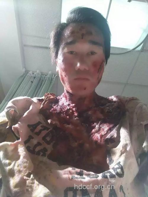 护工被植物人咬竟得艾滋