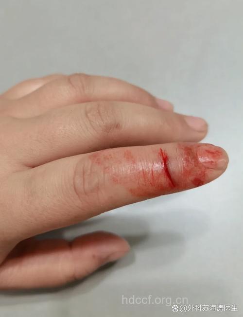 男子手指割伤被要求检查艾滋