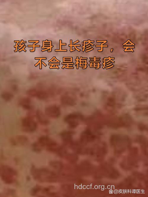 感染梅毒，孩子会不会也有梅毒