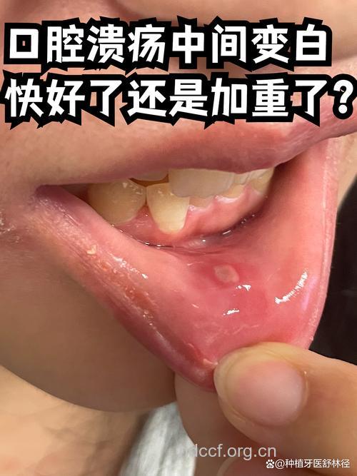 口腔溃疡有哪些症状