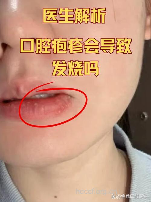 感冒容易引起口腔溃疡吗