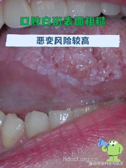 口腔白斑有哪些类型