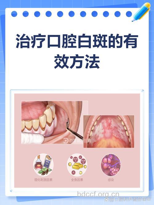 口腔白斑有哪些治疗方法