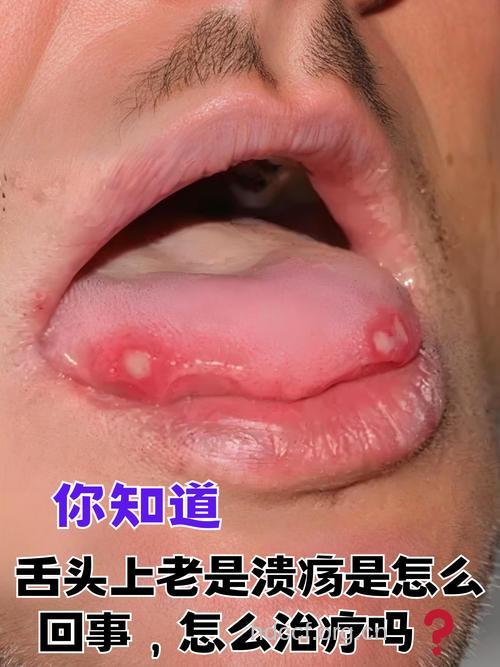 什么是舌头溃疡
