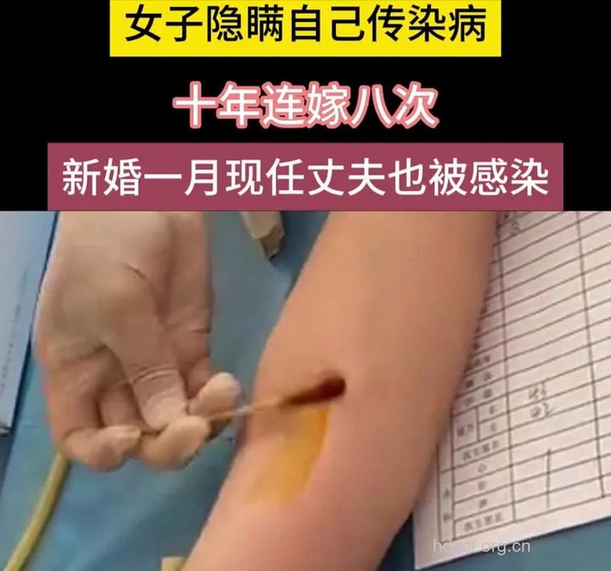 健康女子嫁给艾滋男子 专家称可过夫妻生活