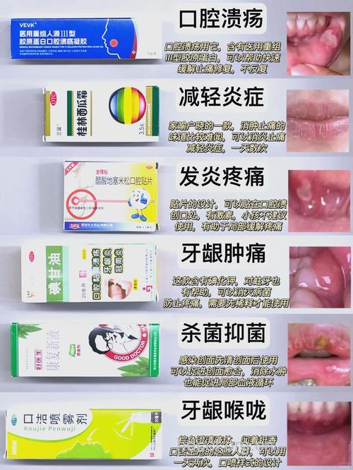 怎么用中药外治口腔溃疡