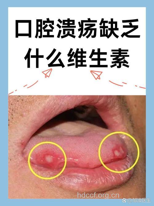 缺乏维生素易引发口腔溃疡