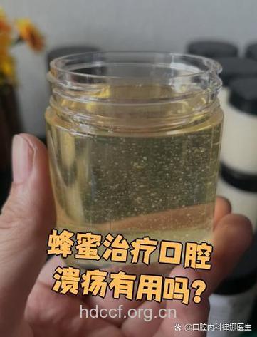 蜂蜜可治疗口腔溃疡