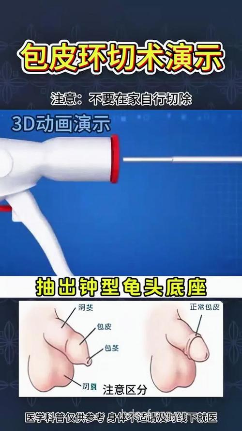 包皮环切新技术帮助非洲防艾