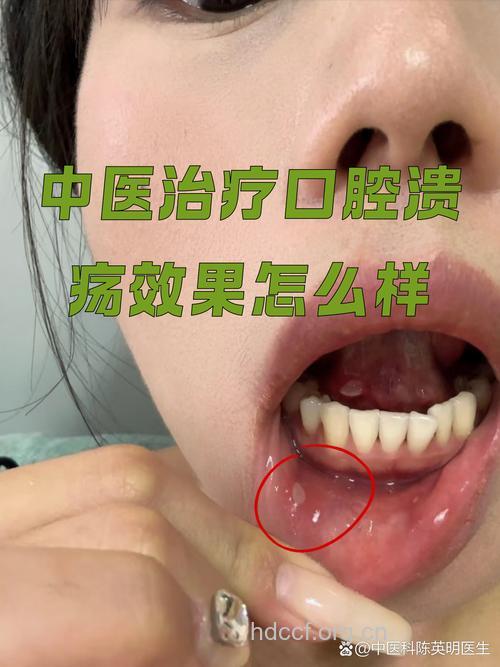 中医治疗口腔溃疡效果好