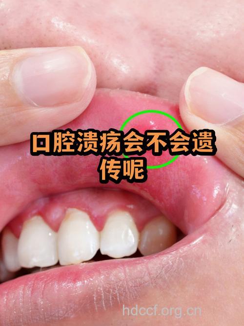 口腔溃疡会遗传吗？