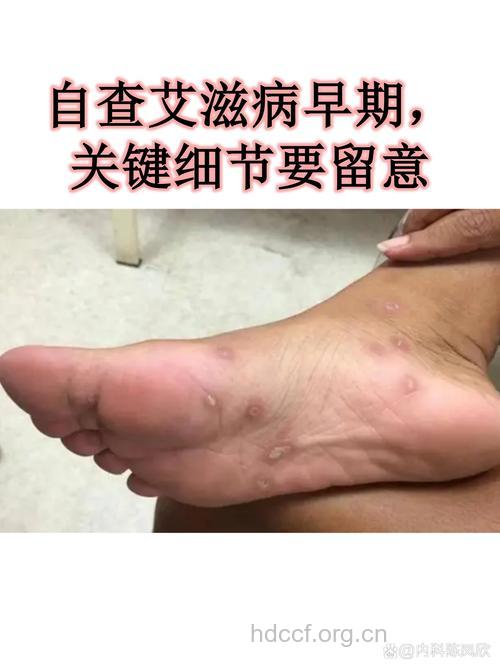 新一代艾滋病人9成不自知